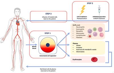 Extracorporeal photopheresis as an immunomodulatory treatment modality for chronic GvHD and the importance of emerging biomarkers